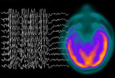 Epilepsy Brain Waves – Photo (c) WebMD.com